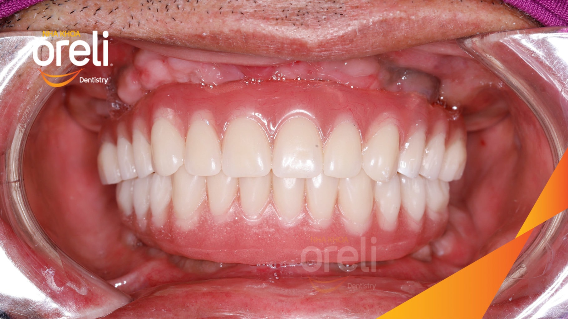 Ca trồng răng Implant chỉnh hô hai hàm tại Oreli