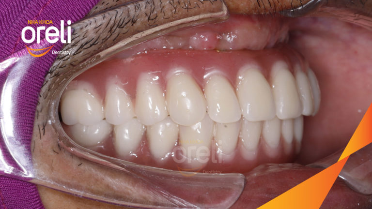 Kết quả Implant hai hàm – Khôi phục răng mất hiệu quả | Oreli