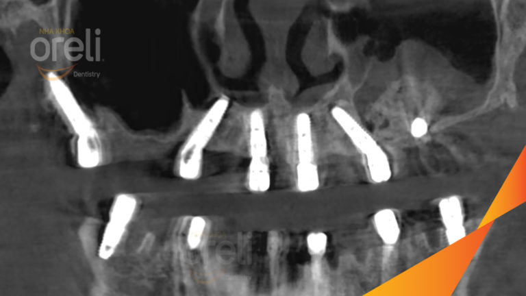 Kết quả Implant hai hàm – Khôi phục răng mất hiệu quả | Oreli