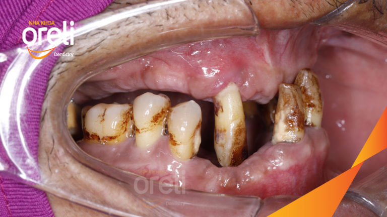 Kết quả Implant hai hàm – Khôi phục răng mất hiệu quả | Oreli