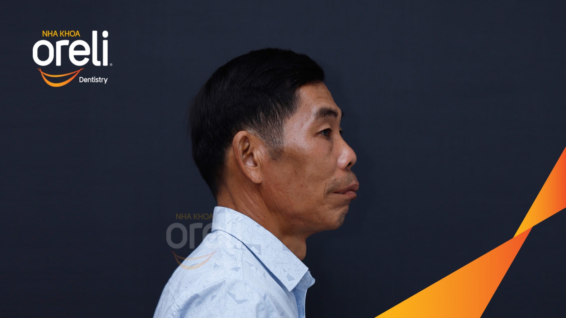 Ca trồng răng Implant chỉnh hô hai hàm tại Oreli