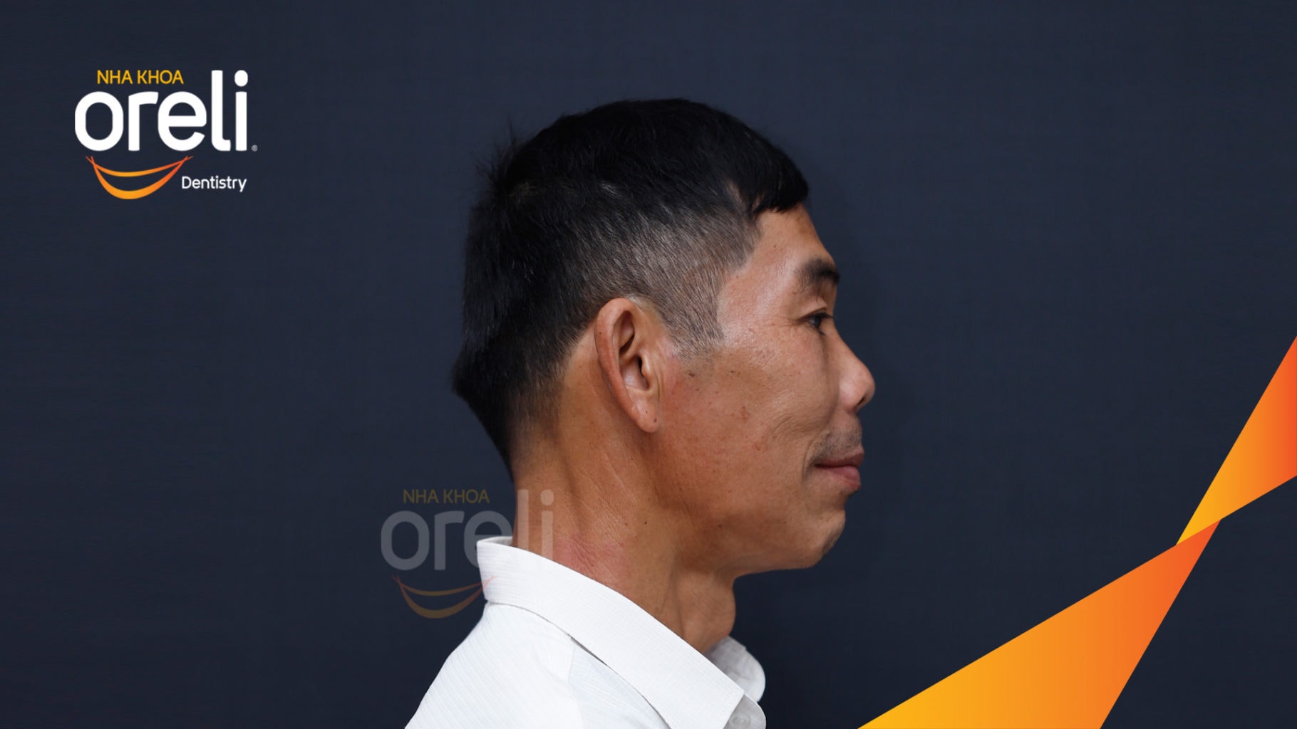 Ca trồng răng Implant chỉnh hô hai hàm tại Oreli