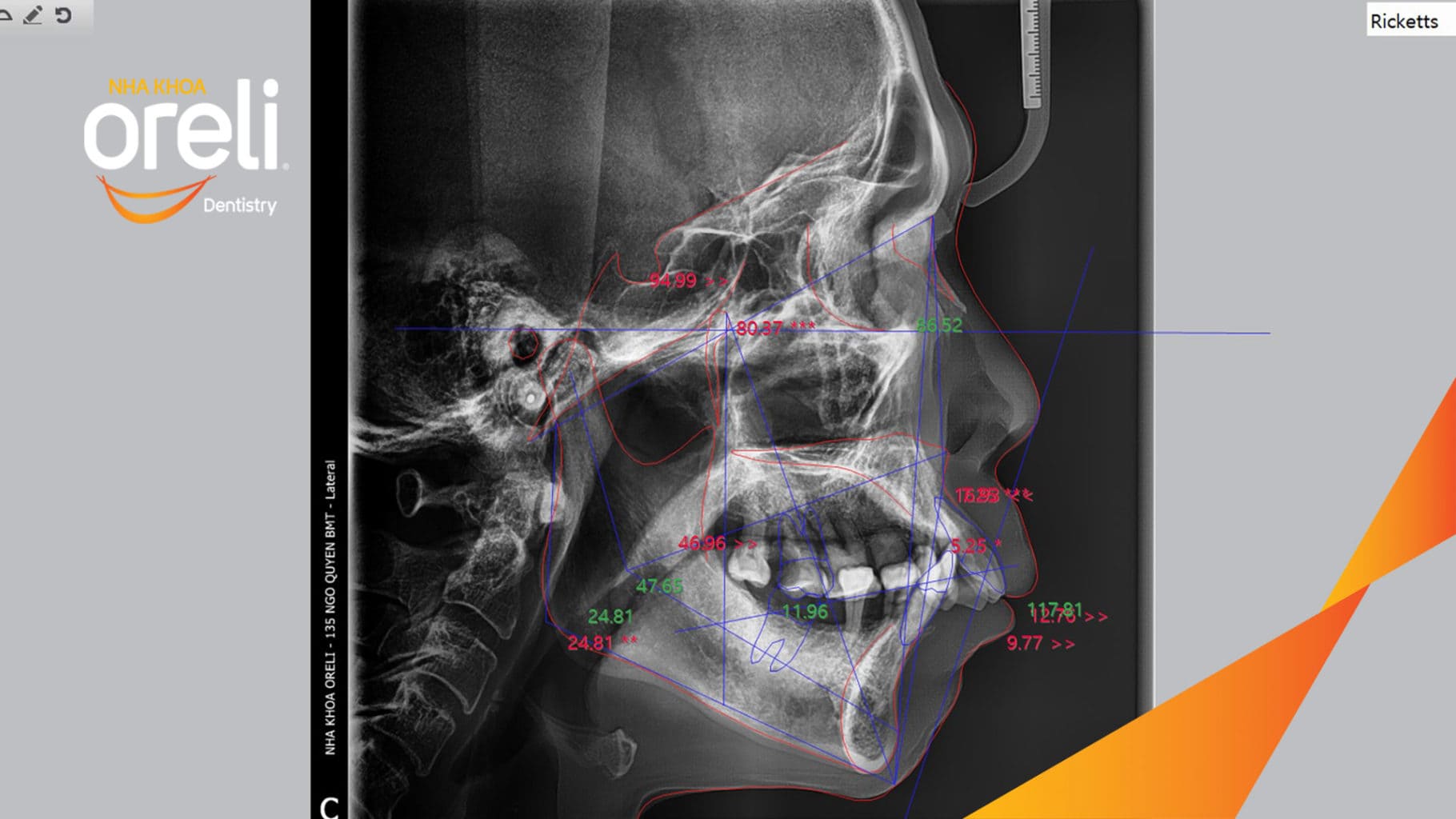 Ca trồng răng Implant chỉnh hô hai hàm tại Oreli