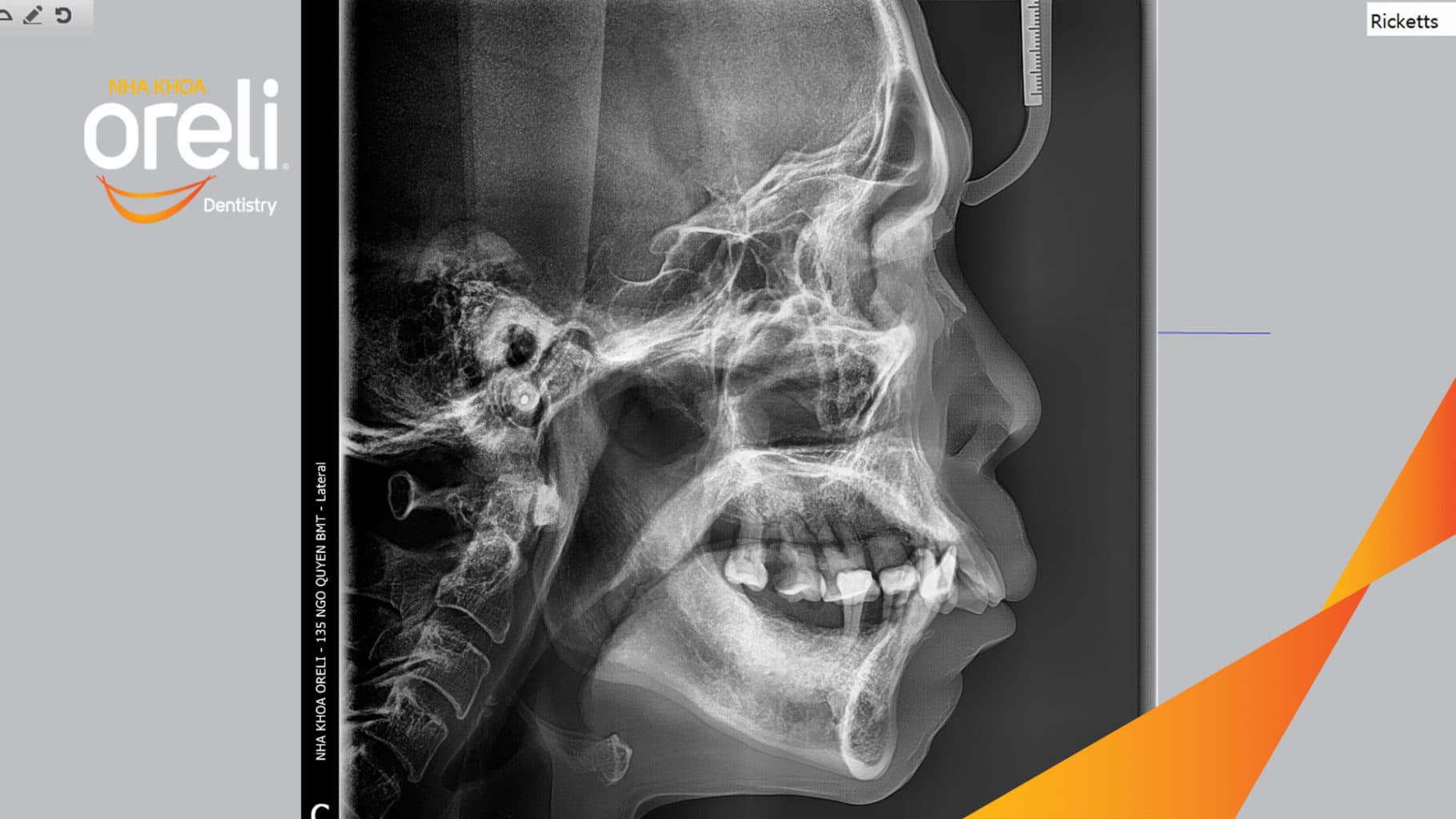 Ca trồng răng Implant chỉnh hô hai hàm tại Oreli