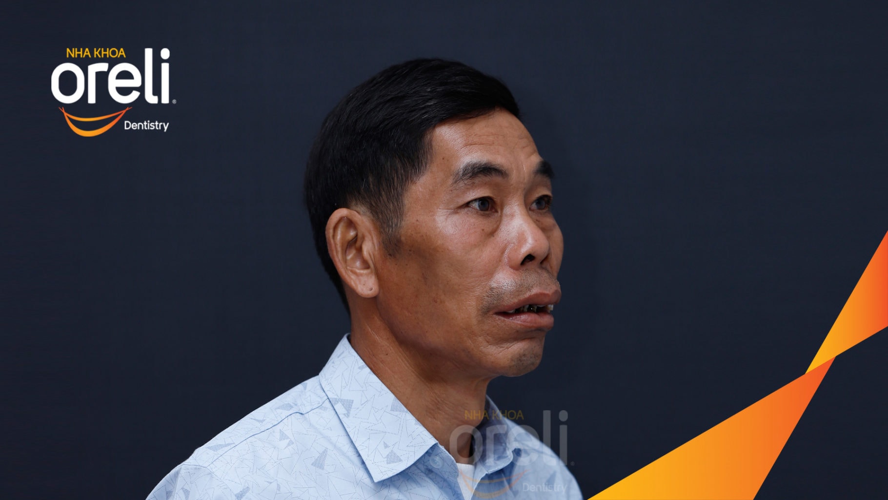 Ca trồng răng Implant chỉnh hô hai hàm tại Oreli