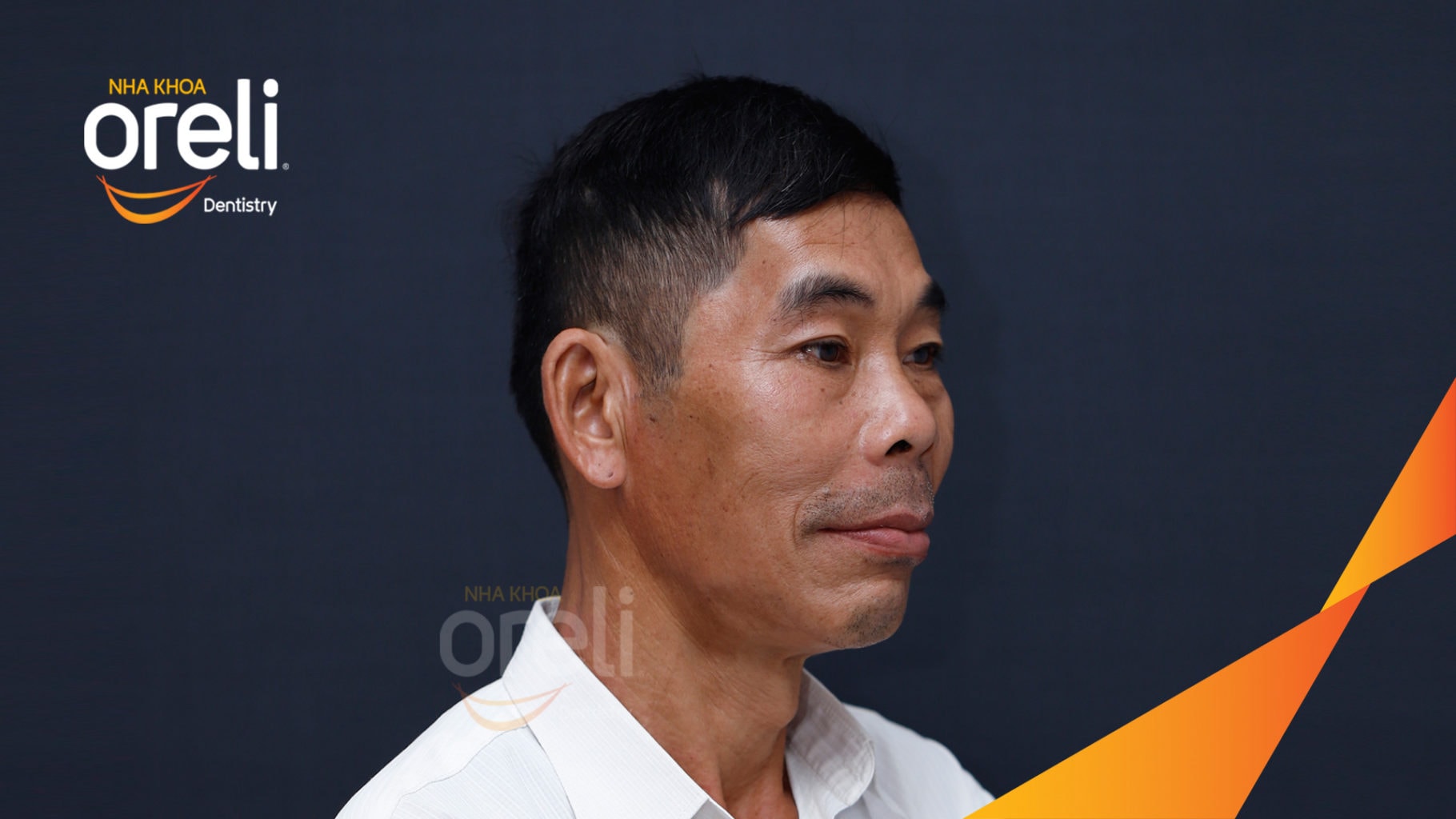 Ca trồng răng Implant chỉnh hô hai hàm tại Oreli