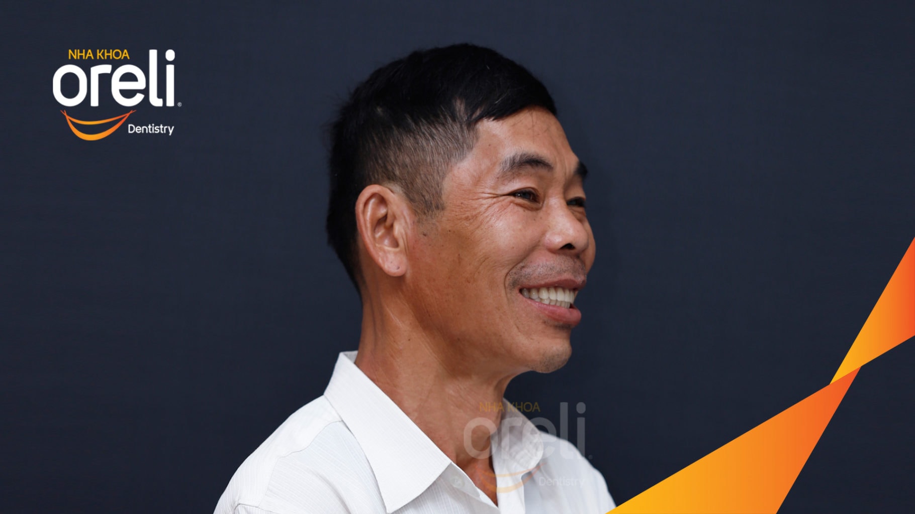 Ca trồng răng Implant chỉnh hô hai hàm tại Oreli