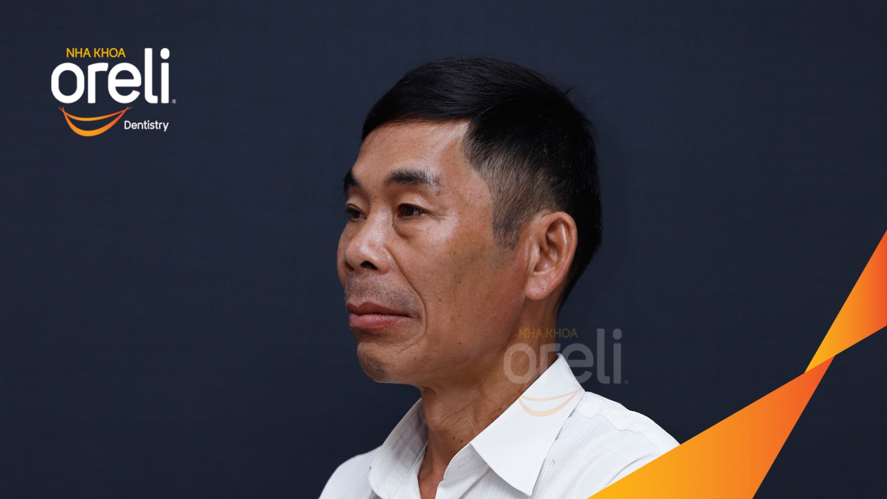 Ca trồng răng Implant chỉnh hô hai hàm tại Oreli