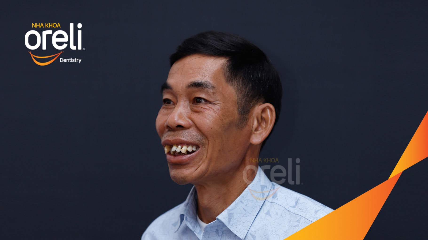 Ca trồng răng Implant chỉnh hô hai hàm tại Oreli