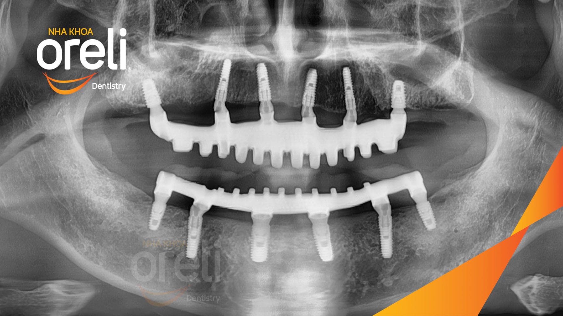 Ca trồng răng Implant chỉnh hô hai hàm tại Oreli
