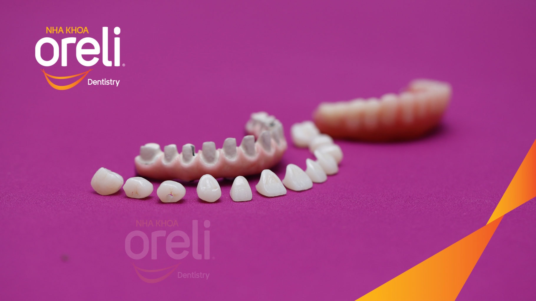 Ca trồng răng Implant chỉnh hô hai hàm tại Oreli