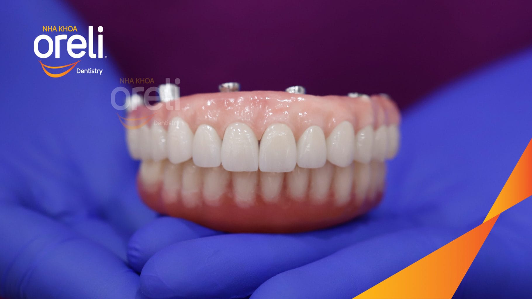 Ca trồng răng Implant chỉnh hô hai hàm tại Oreli