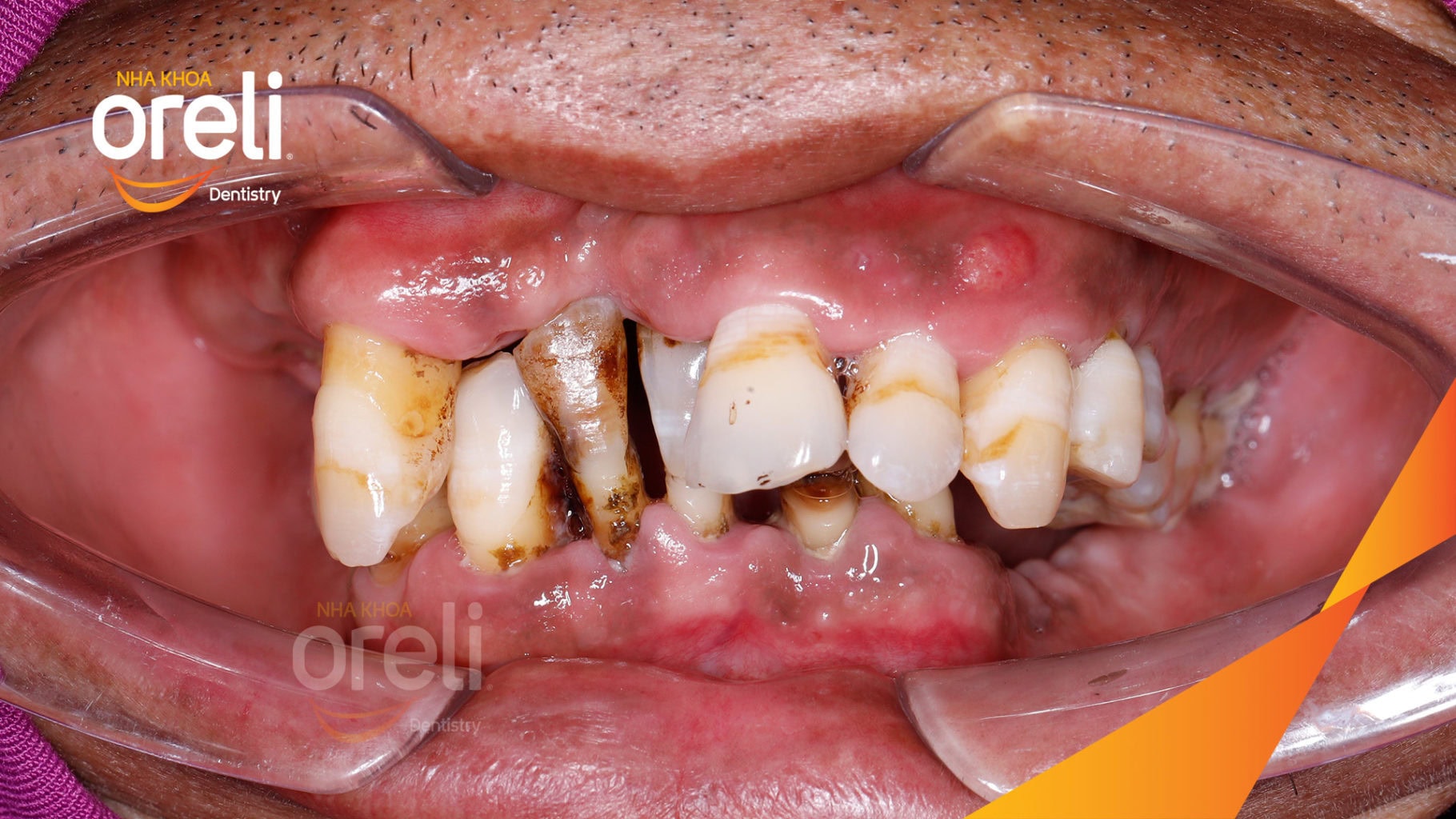 Ca trồng răng Implant chỉnh hô hai hàm tại Oreli