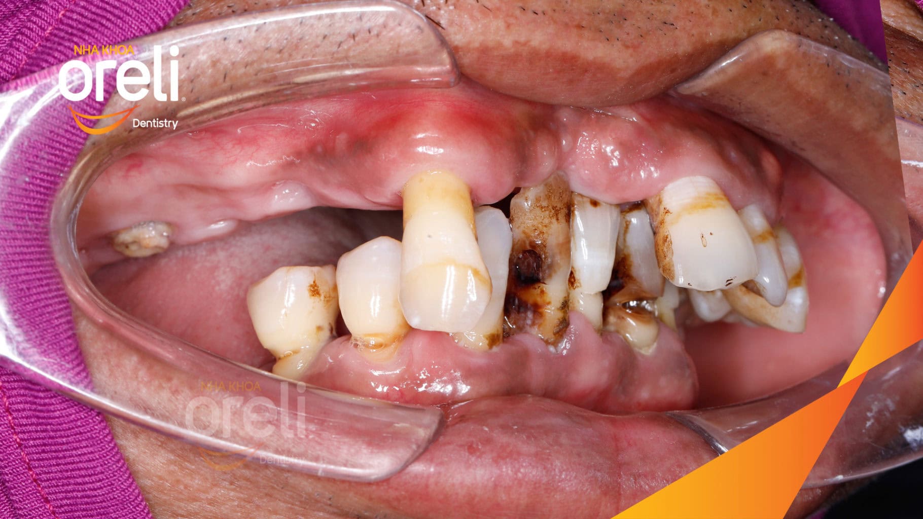 Ca trồng răng Implant chỉnh hô hai hàm tại Oreli