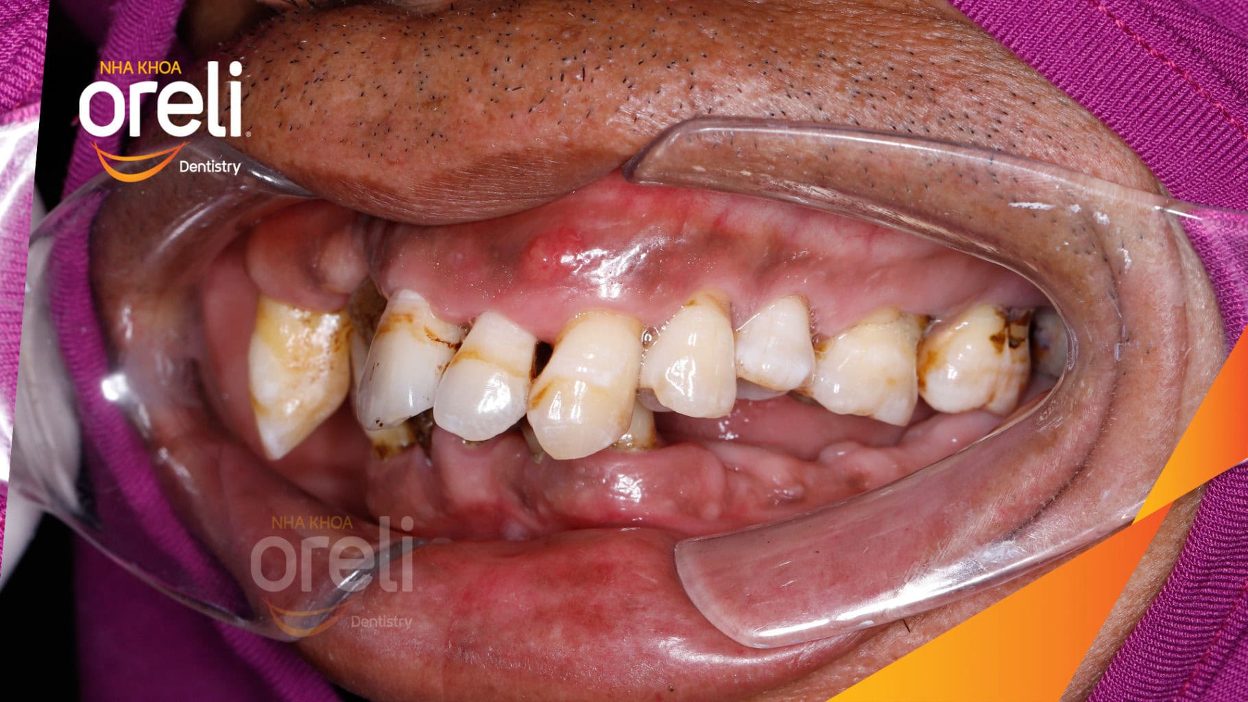 Ca trồng răng Implant chỉnh hô hai hàm tại Oreli