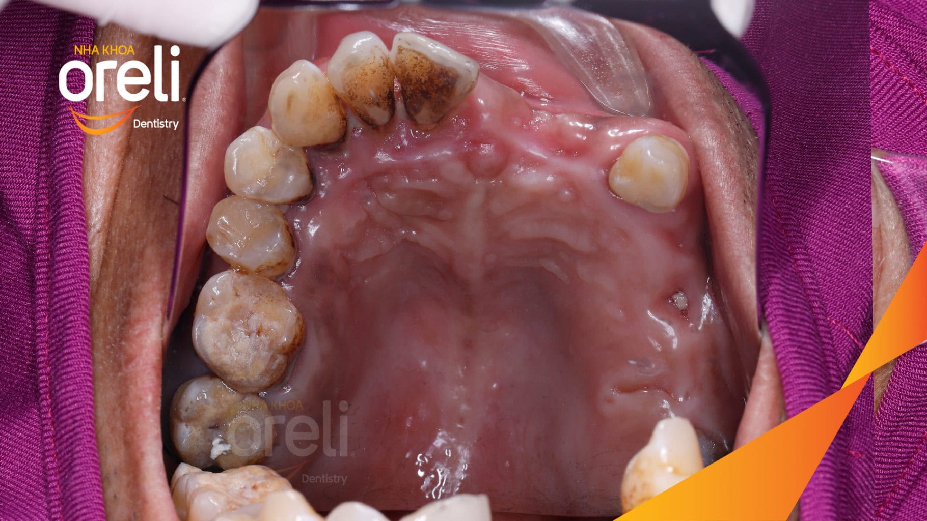 Ca trồng răng Implant chỉnh hô hai hàm tại Oreli