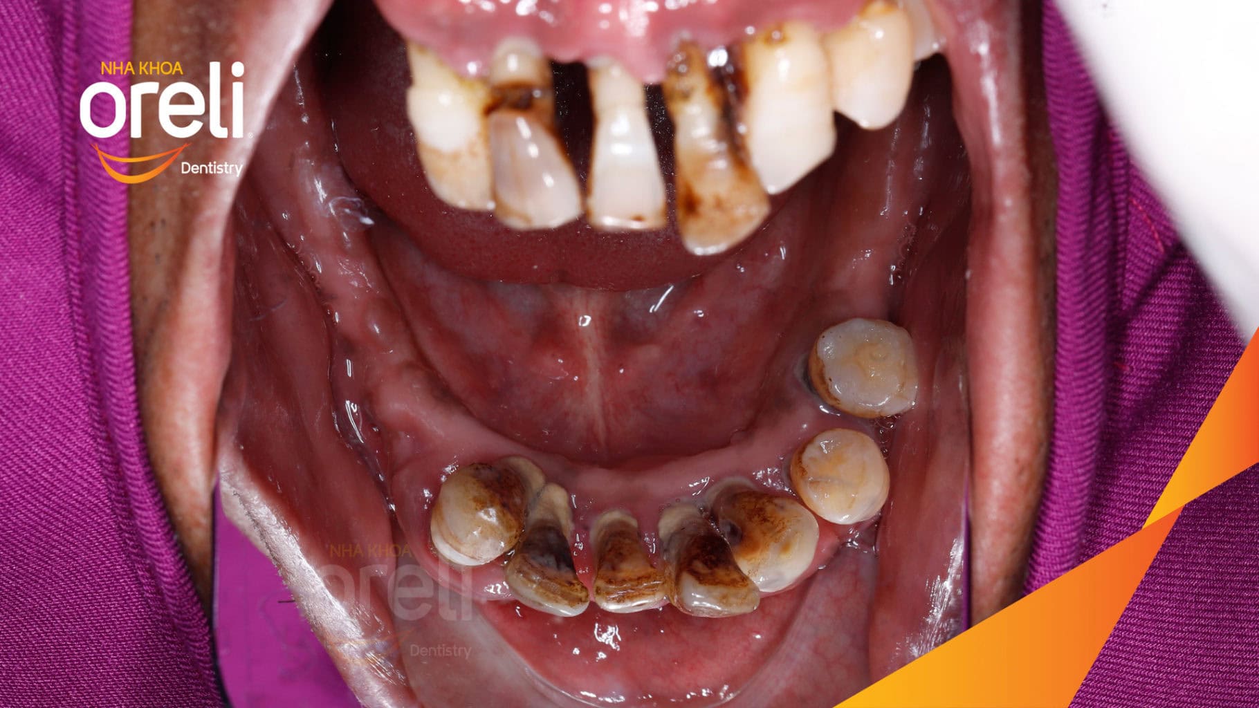 Ca trồng răng Implant chỉnh hô hai hàm tại Oreli