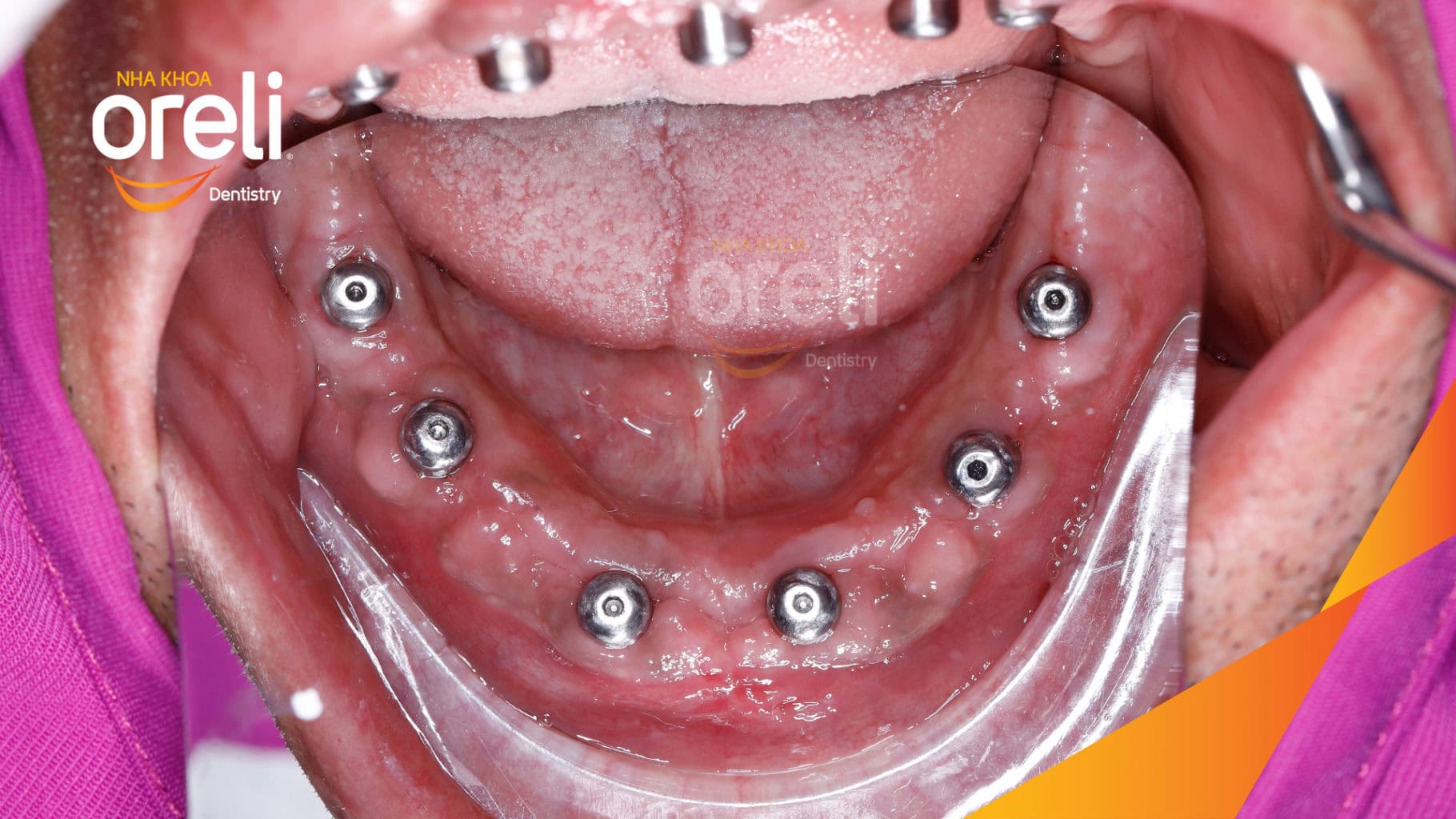 Ca trồng răng Implant chỉnh hô hai hàm tại Oreli