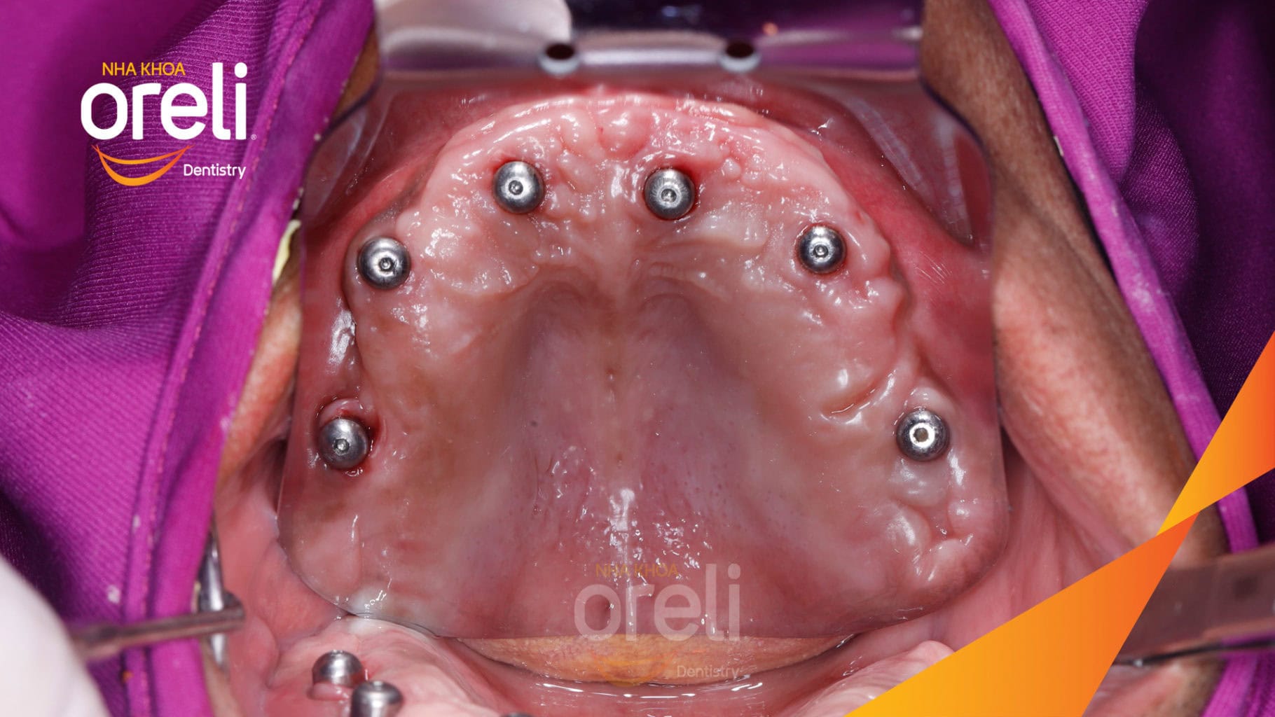 Ca trồng răng Implant chỉnh hô hai hàm tại Oreli
