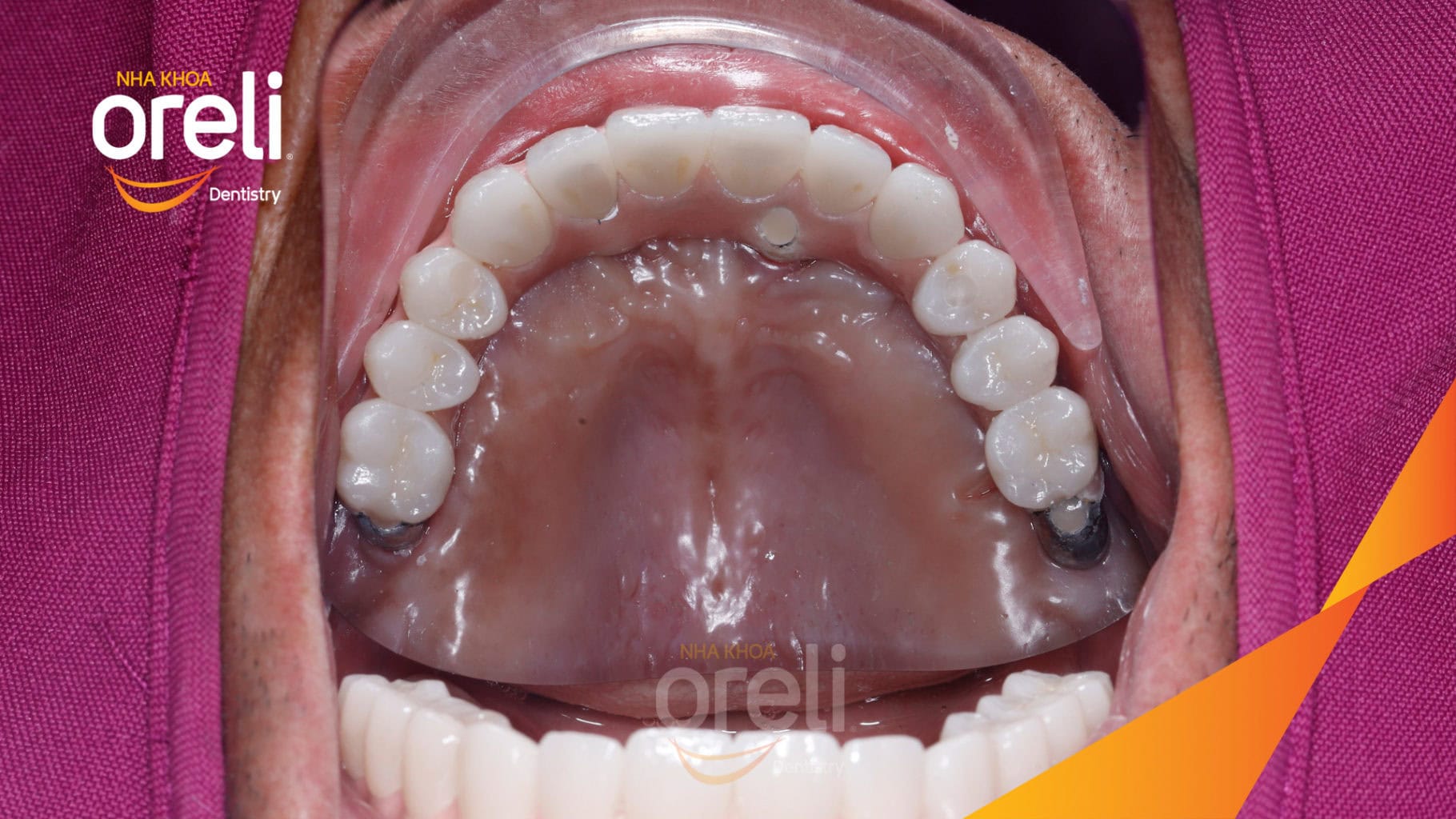 Ca trồng răng Implant chỉnh hô hai hàm tại Oreli