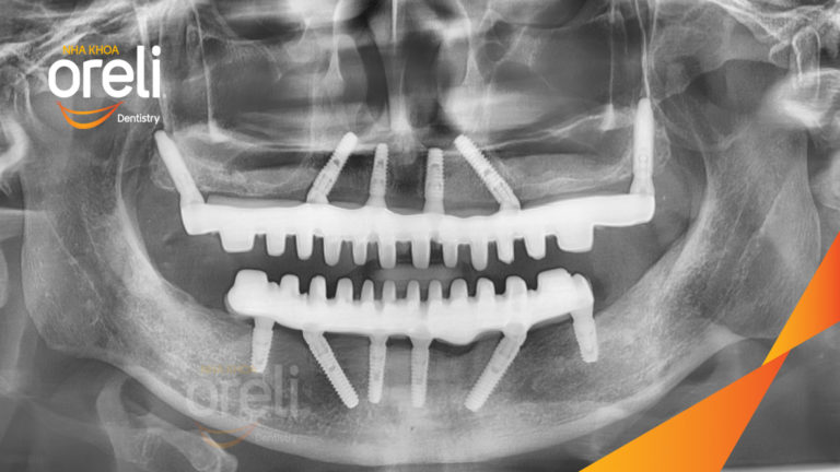 Ca Implant hai hàm – Phục hồi răng mất kèm tiêu xương hàm | Oreli