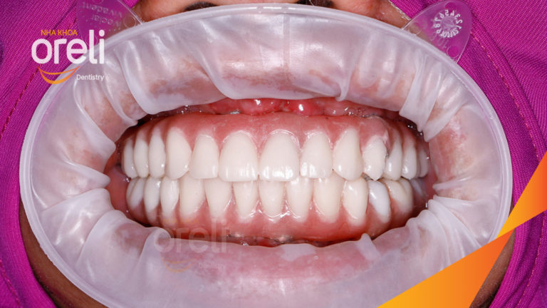 Ca Implant hai hàm – Phục hồi răng mất kèm tiêu xương hàm | Oreli