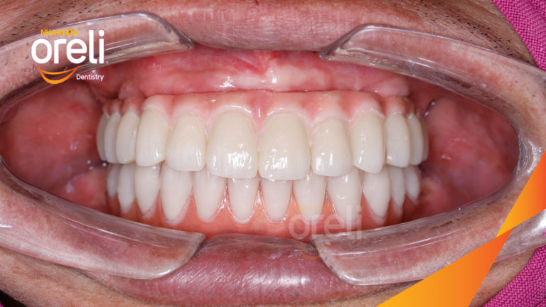 Ca trồng răng hai hàm giải quyết tình trạng tiêu xương trầm trọng – Ổn định ăn nhai và thẩm mỹ | Oreli