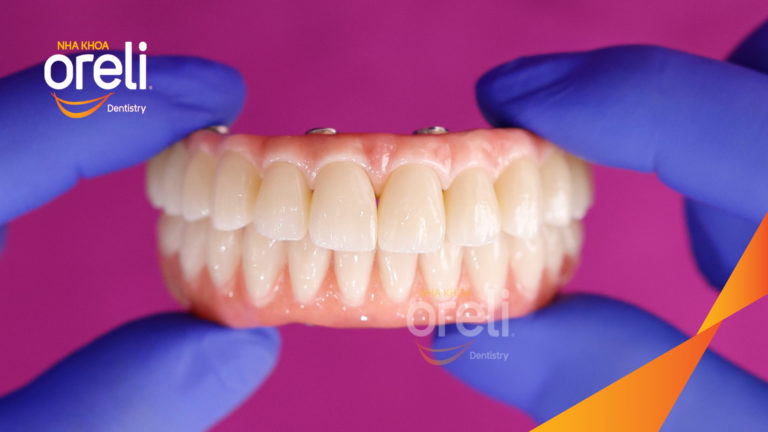 Ca trồng răng hai hàm giải quyết tình trạng tiêu xương trầm trọng – Ổn định ăn nhai và thẩm mỹ | Oreli