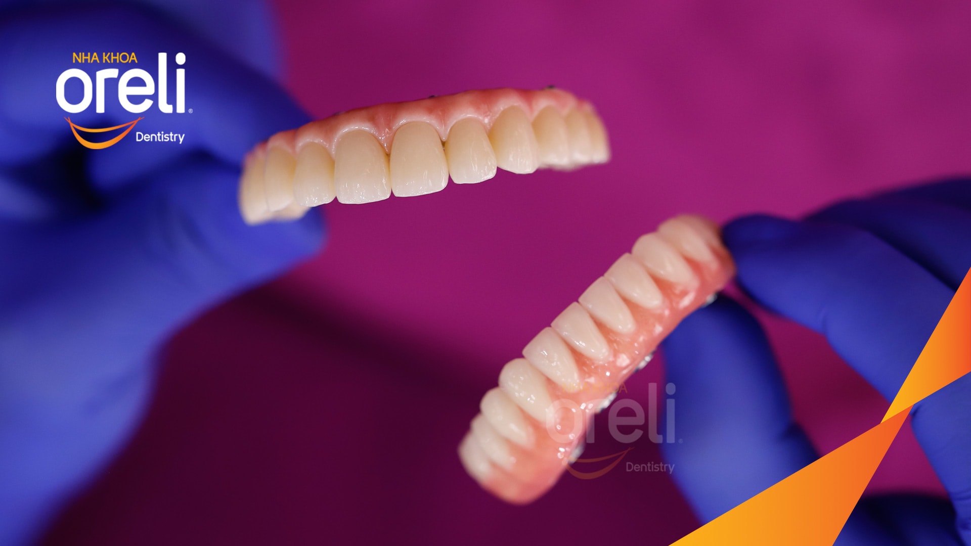 cấy ghép implant toàn hai hàm