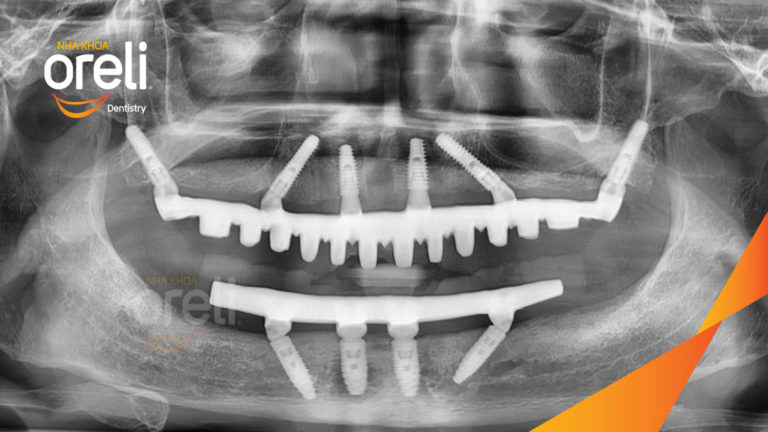 Ca trồng răng hai hàm giải quyết tình trạng tiêu xương trầm trọng – Ổn định ăn nhai và thẩm mỹ | Oreli