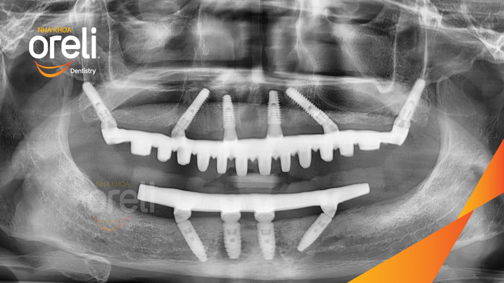 cấy ghép implant toàn hai hàm