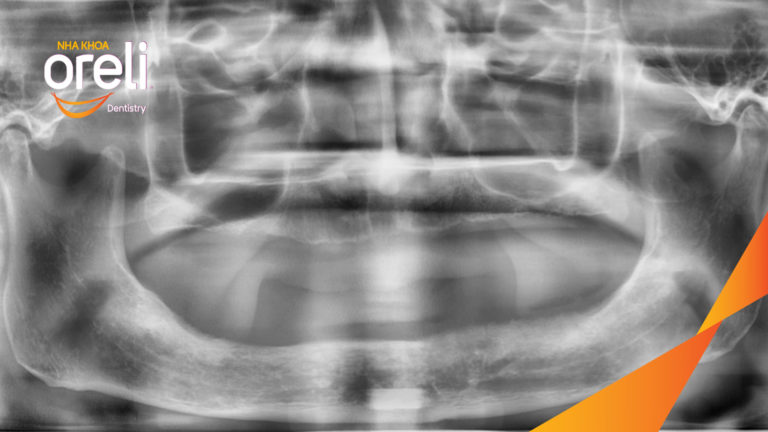Ca trồng răng hai hàm giải quyết tình trạng tiêu xương trầm trọng – Ổn định ăn nhai và thẩm mỹ | Oreli