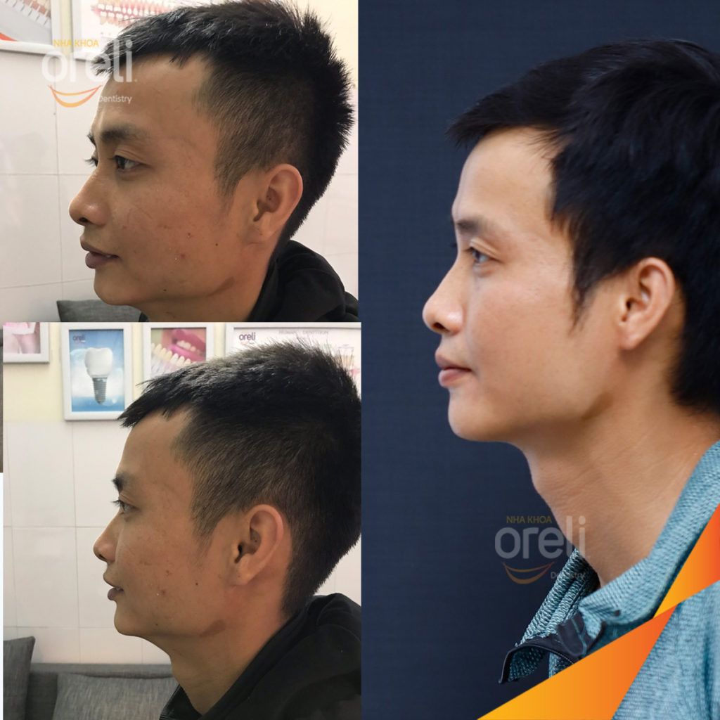nieng rang sai khop can nang oreli