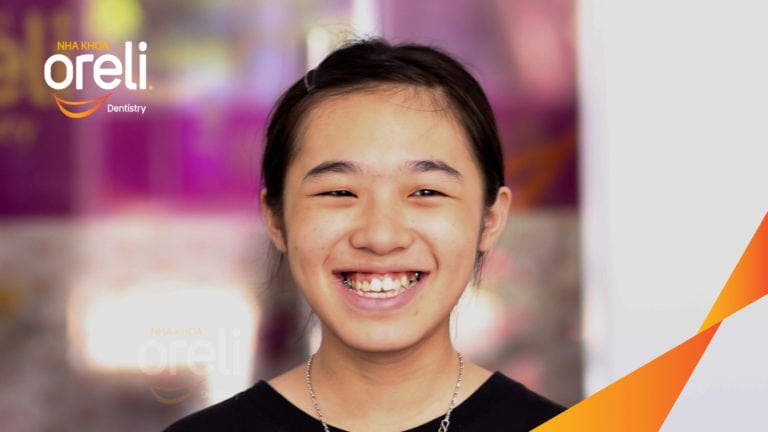 Ca niềng răng sai khớp cắn hạng 3 móm nặng có nhổ răng số 7 – Kết quả thực tế