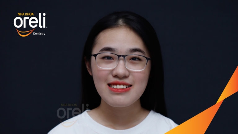 Ca niềng răng sai khớp cắn hạng 3 móm nặng có nhổ răng số 7 – Kết quả thực tế