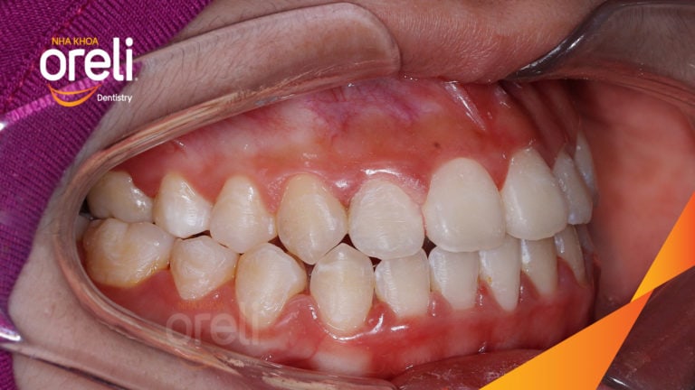 Ca niềng răng sai khớp cắn hạng 3 móm nặng có nhổ răng số 7 – Kết quả thực tế