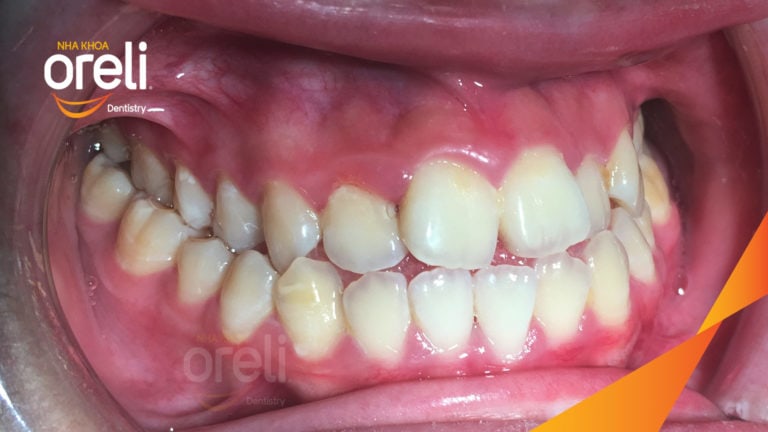 Ca niềng răng sai khớp cắn hạng 3 móm nặng có nhổ răng số 7 – Kết quả thực tế