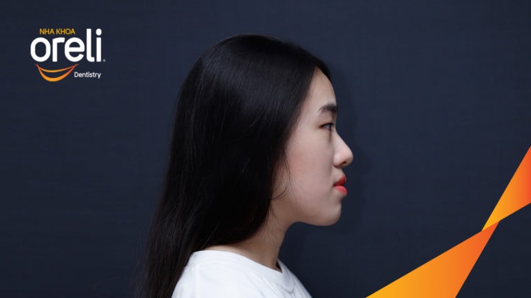 Ca niềng răng sai khớp cắn hạng 3 móm nặng có nhổ răng số 7 – Kết quả thực tế