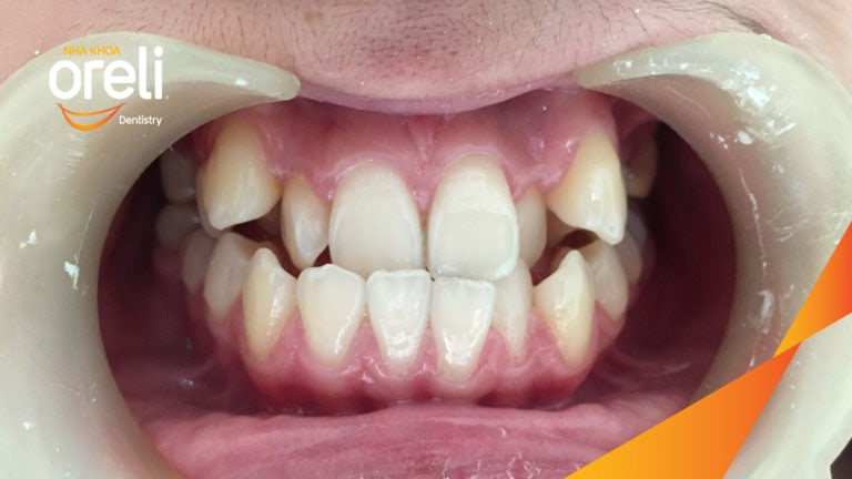 Ca chỉnh móm chen chúc răng nặng kết quả thay đổi nụ cười tại Oreli