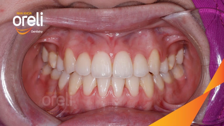 Ca chỉnh móm chen chúc răng nặng kết quả thay đổi nụ cười tại Oreli