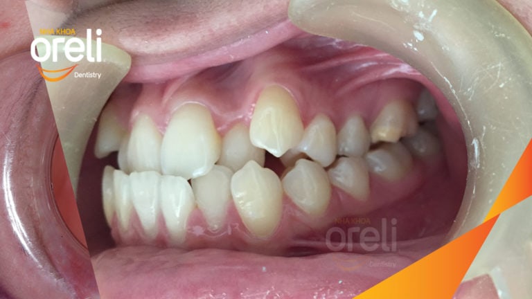 Ca chỉnh móm chen chúc răng nặng kết quả thay đổi nụ cười tại Oreli