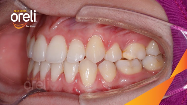 Ca chỉnh móm chen chúc răng nặng kết quả thay đổi nụ cười tại Oreli