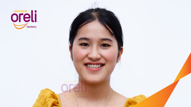 nieng rang mom uy tin bmt oreli