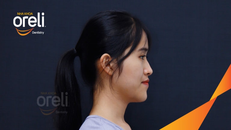 Ca niềng chỉnh móm chen chúc nặng hai hàm kết quả thay đổi nụ cười khuôn mặt tại Oreli