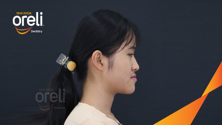Ca niềng chỉnh móm chen chúc nặng hai hàm kết quả thay đổi nụ cười khuôn mặt tại Oreli