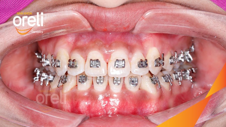 Ca niềng chỉnh móm chen chúc nặng hai hàm kết quả thay đổi nụ cười khuôn mặt tại Oreli