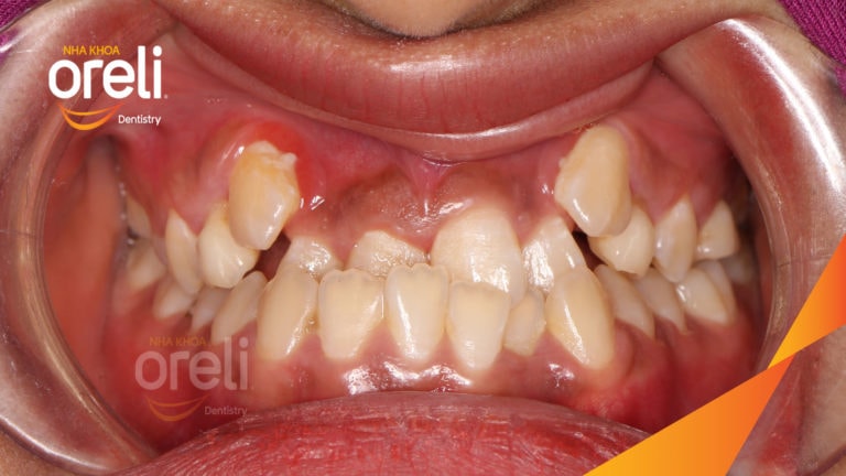 Ca niềng chỉnh móm chen chúc nặng hai hàm kết quả thay đổi nụ cười khuôn mặt tại Oreli