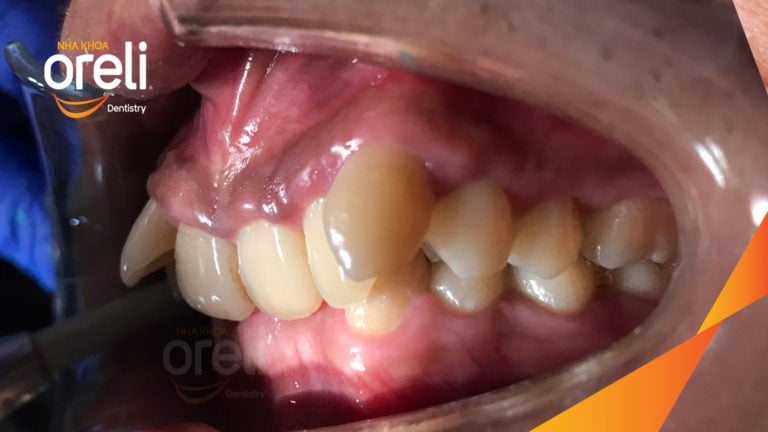 nieng rang sai khop can nang oreli