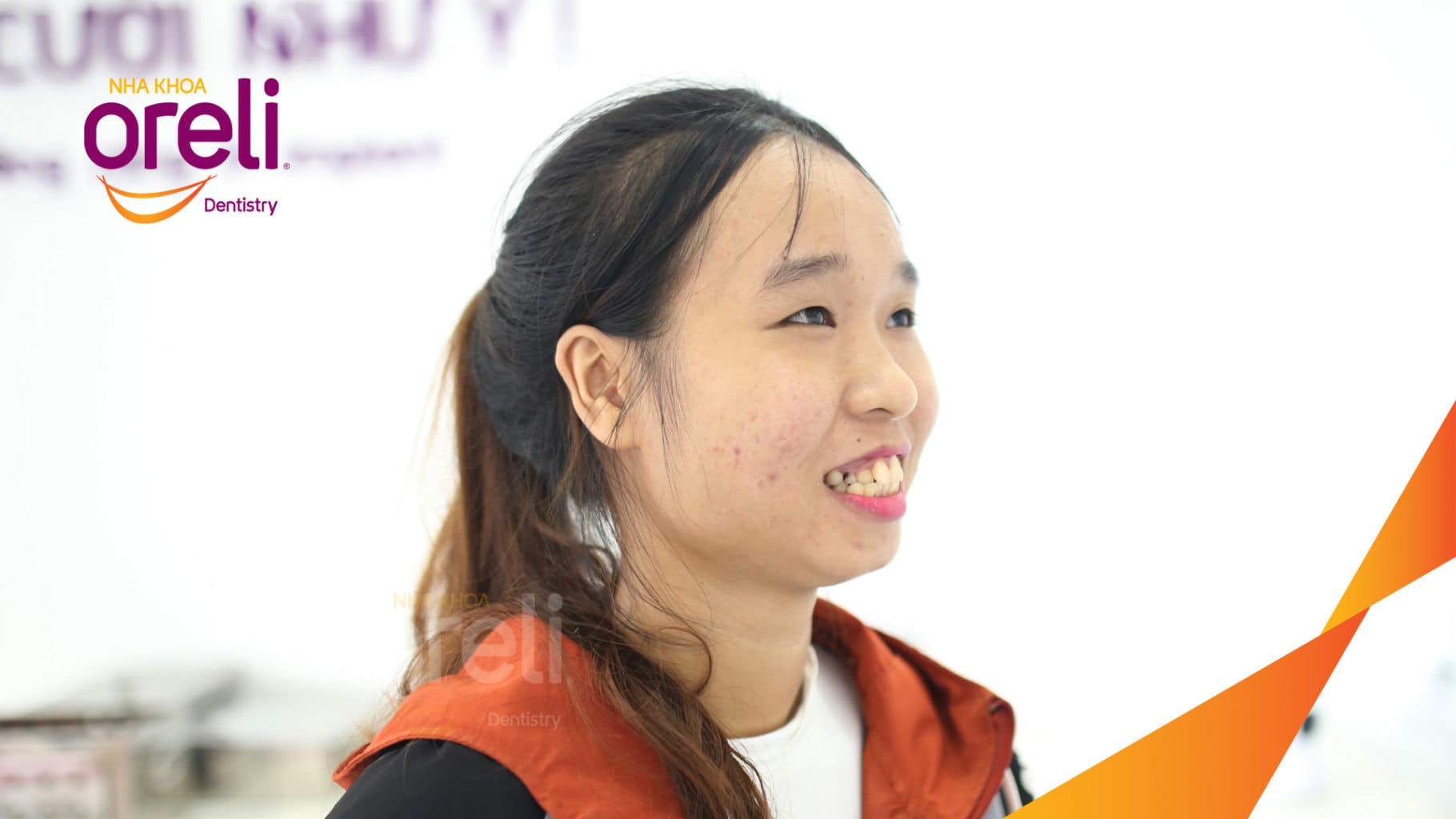 Niềng răng hô nhổ 4 răng số 4 – Bao lâu thì đẹp? Case thực tế