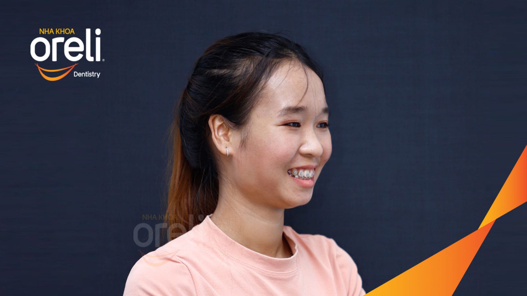 Niềng răng hô nhổ 4 răng số 4 – Bao lâu thì đẹp? Case thực tế